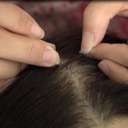 Implants de cheveux synthétiques