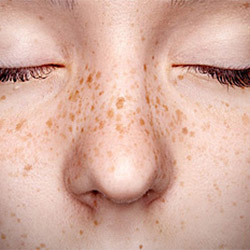 Facial Freckles