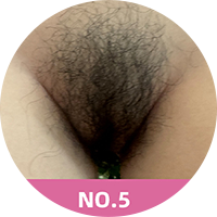 Vello púbico #5