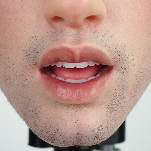 Beard Implantation